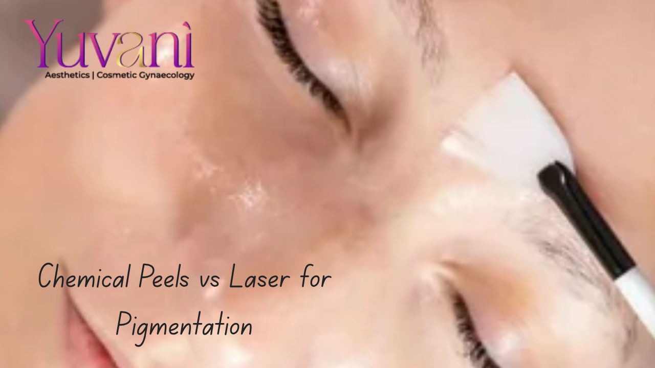 Chemical Peels vs Laser for Pigmentation