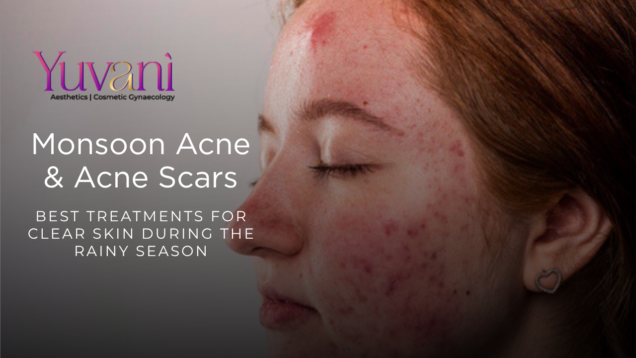 Monsoon Acne & Acne Scars: Best Treatments for Clear Skin During the Rainy Season