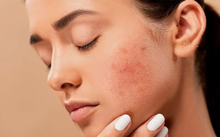Acne scar treatment in Kharghar, Navi Mumbai