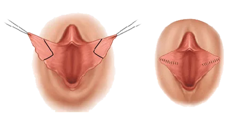 labia revision treatment at yuvani clinic