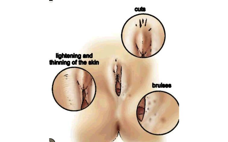 Areas affecting Lichen Sclerosus