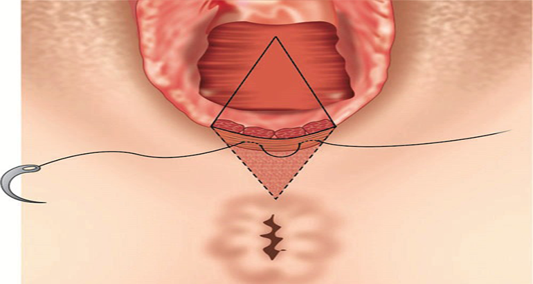 Perineal Body Reconstruction