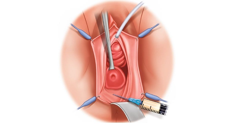 vaginal lightning procedure