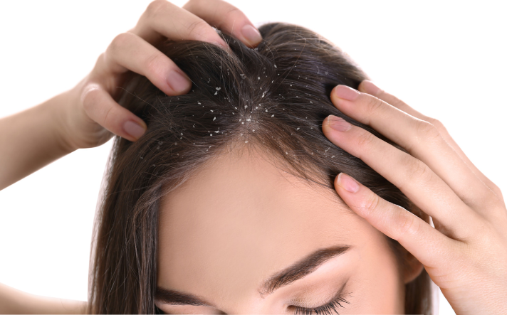 Anti dandruff treatment at yuvani clinic