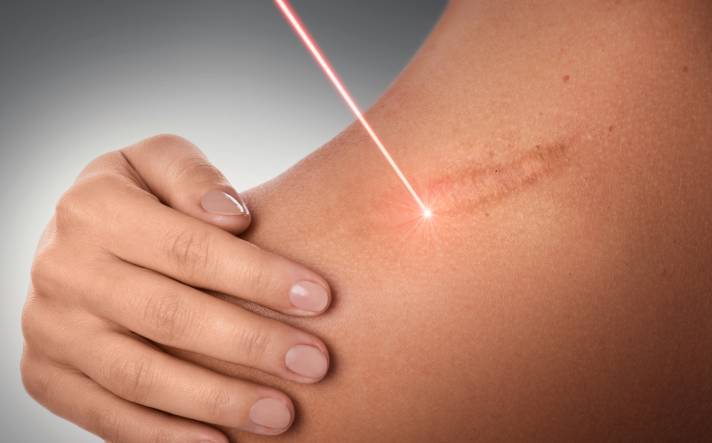 Acne scar treatment in Navi Mumbai