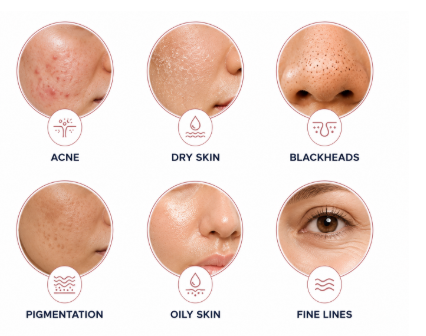 Grid chart mapping treatable skin concerns like acne, blackheads, pigmentation, and excess sebum.